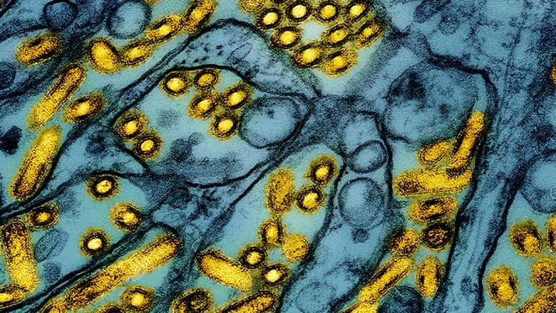 CDC confirms first severe case of H5N1 bird flu in U.S.